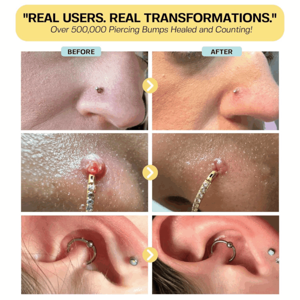 Piercing Keloid Bumps Shrinking Duo | Piercing Bump Treatment (.5Oz) + Keloid Bump Removal Gel (2Oz) | Keloid Scar Removal for All Scars, Keloids & Piercing Bumps - Image 4